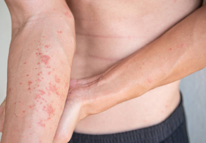 Sakit sa Balat dulot ng Eczema – Sintomas at Gamot