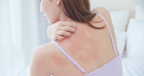 Ano ang mga bawal na pagkain sa may Eczema?