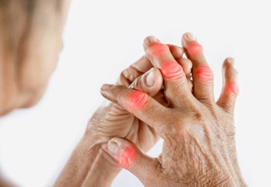 Mabisang Gamot sa Arthritis – Sakit sa mga Kasu-kasuan