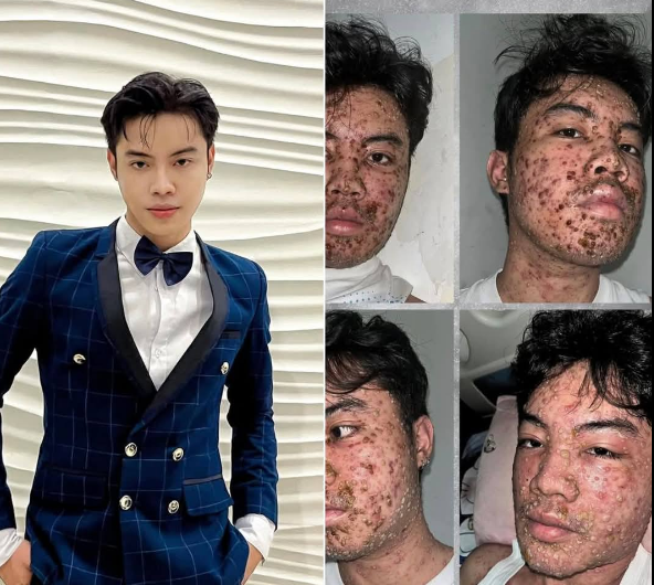 Nakamamatay ba ang monkey pox (MPOX)