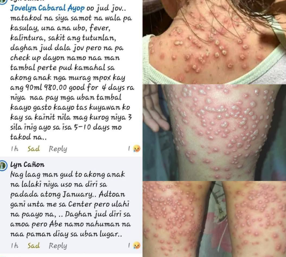 Paano maiiwasan ang MPOX – Mga detalye ng sakit